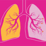 2. COPD – Chronic Obstructive Pulmonary Disorder