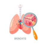 Bronchitis: Understanding Cough and How to Manage It