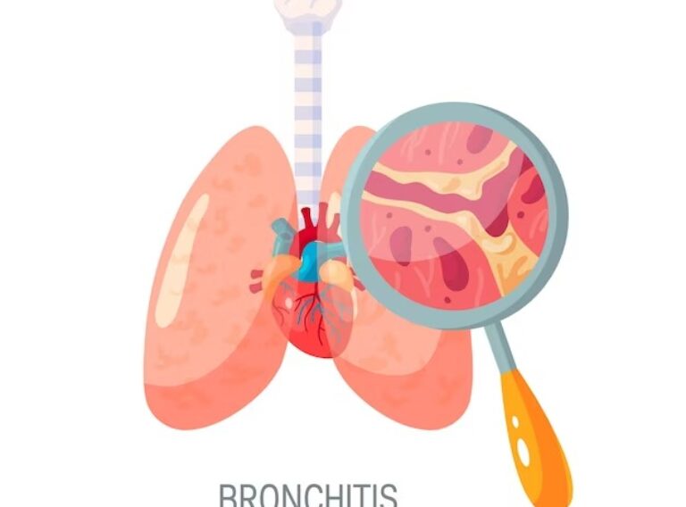 Bronchitis